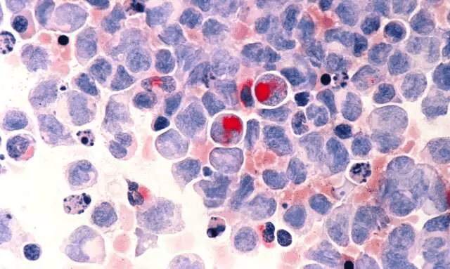Anvisa aprova medicamento para tratar tipo agressivo de linfoma