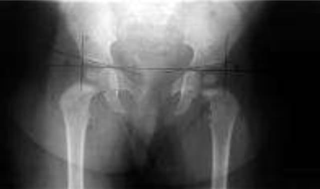 Justiça limita ressarcimento em ação que cobra cirurgia de R$ 239 mil do SUS